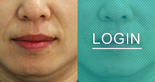 [쁘띠] 리쥬필 : 팔자주름 필러