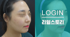 [쁘띠클리닉] 이마,코,팔자,턱