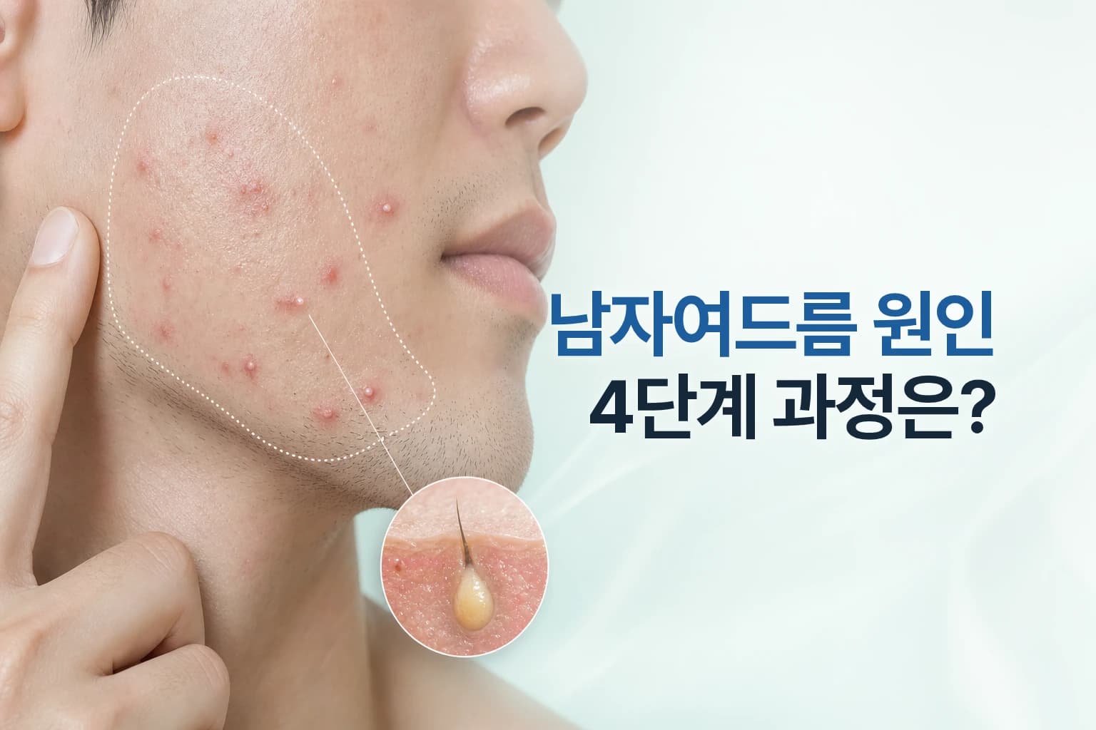 남성 볼과 턱선의 여드름 피부와 피지로 막힌 모공 단면 인셋을 조합한 남자여드름 원인 썸네일