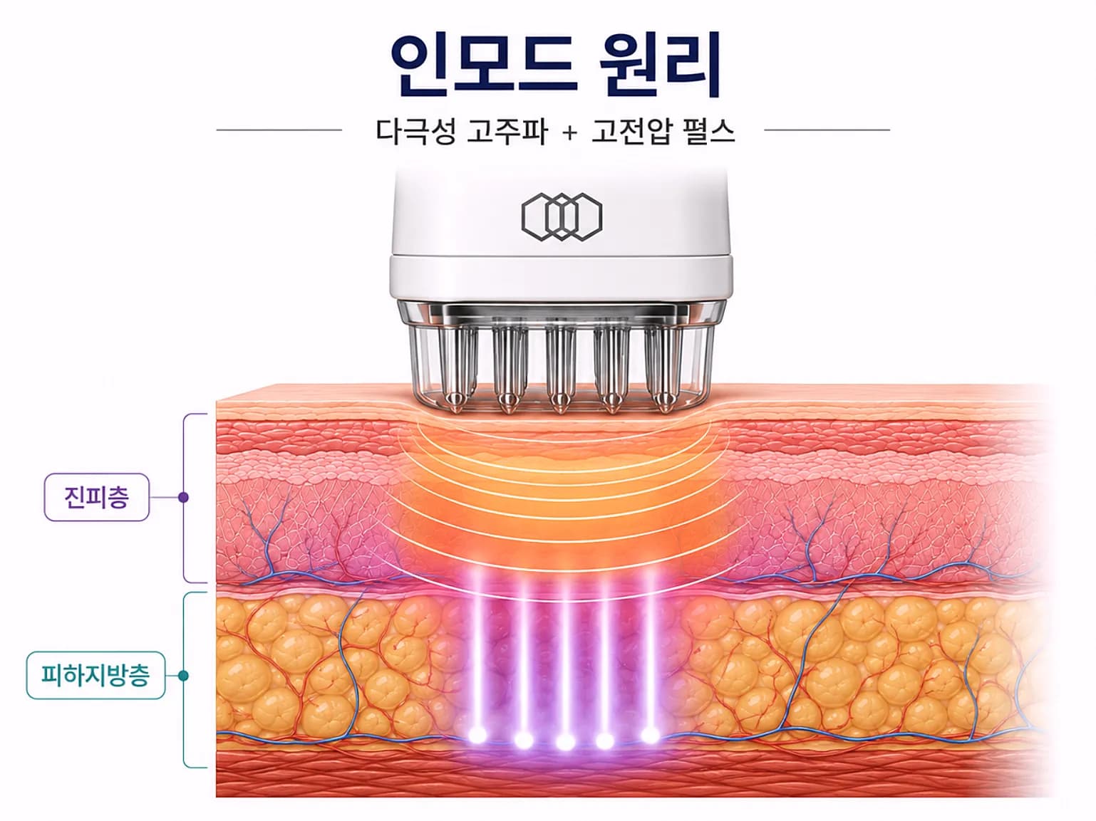 인모드 원리 - 다극성 고주파 고전압 펄스